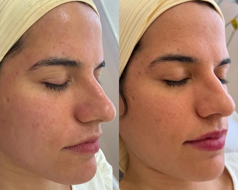 Antes e depois de limpeza de pele, paciente real da Dra. Karina Oliveira