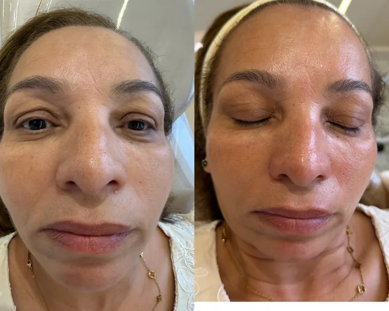 Resultado de limpeza de pele profunda, antes e depois de paciente real
